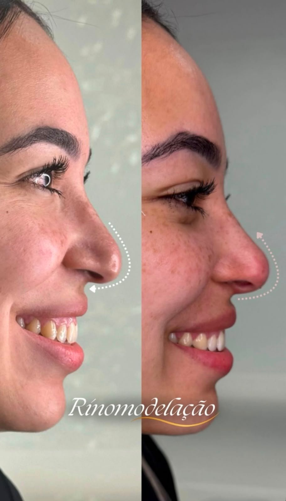Resultado de rinomodelação antes e depois